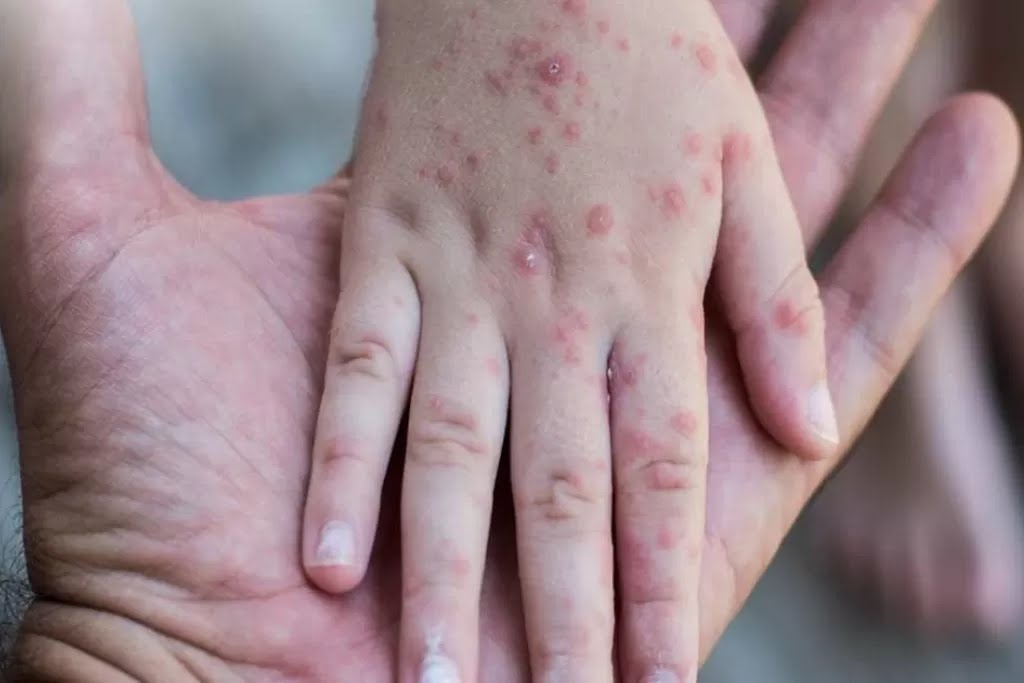 Masyarakat Jawa Barat Diimbau Waspadai Penularan Campak Saat Mudik Idulfitri