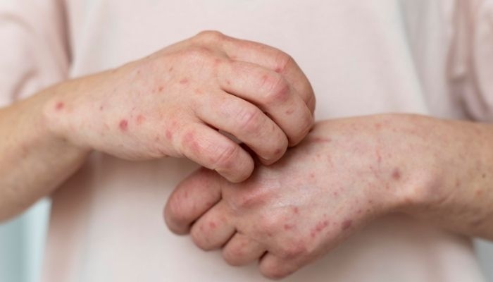 Jumlah Kasus Meningkat, Kemenkes Keluarkan Surat Edaran Waspada Campak untuk Nakes