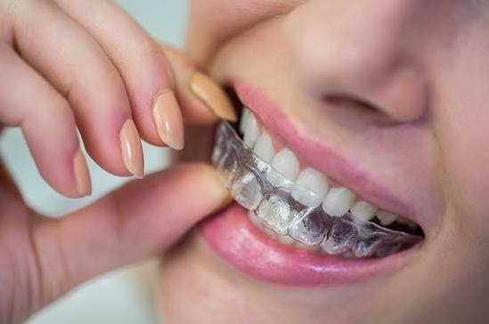 Ingin Pakai Behel Transparan? Ini Biaya dan Keunggulannya