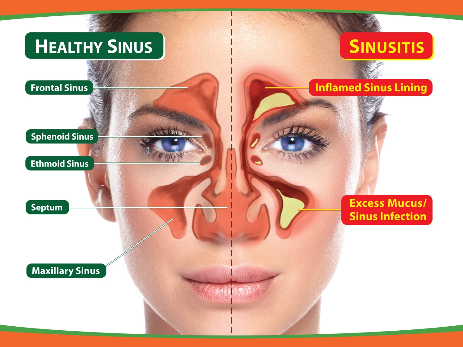 Mengapa Sinusitis Sering Kambuh? Ini Penyebab dan Cara Mencegahnya