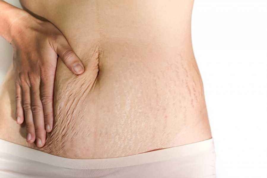 Intip Yuk! 5 Cara Mencegah Stretch Mark Pada Remaja, Pastikan Kulit Tetap Ternutrisi Lho!