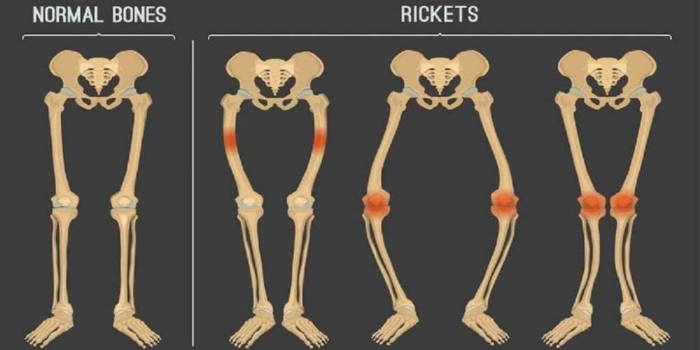 Kenali 5 Tanda Rakitis, Salah Satunya Gangguan Pada Gigi