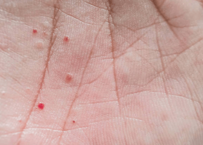 Jari Tangan Timbul Lenting Berisi Air? Hindari Faktor Penyebabnya