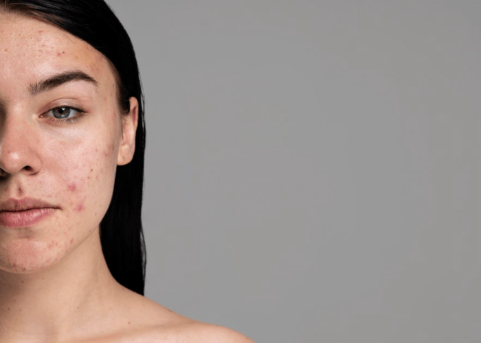 7 Jenis Makanan Yang Harus Dihindari Penderita Jerawat Batu, Salah Satunya Gorengan