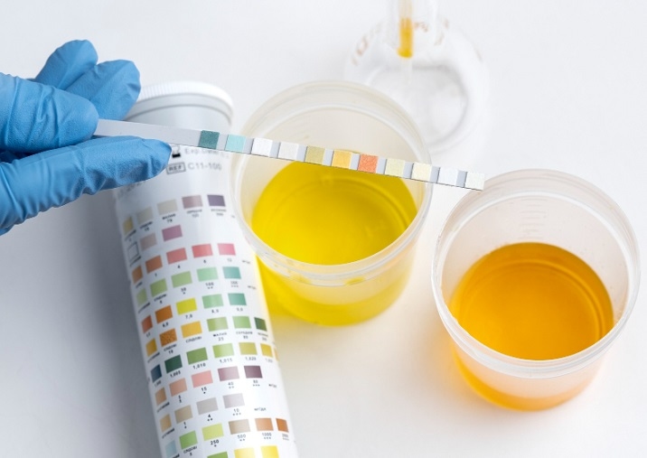 Waspada, Ini Warna Urine Ketika Mengalami Gagal Ginjal