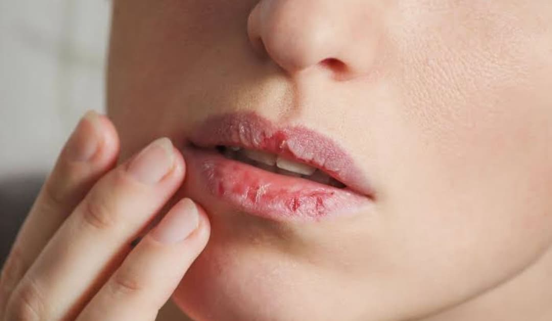 Apa Penyebab Bibir dan Kulit Sekitar Mulut Kering? Kenali Faktor Pemicunya
