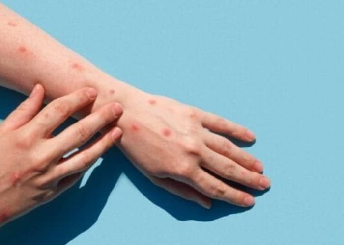 Perhatian, Ini Gejala Monkeypox dan Cara Pencegahannya 
