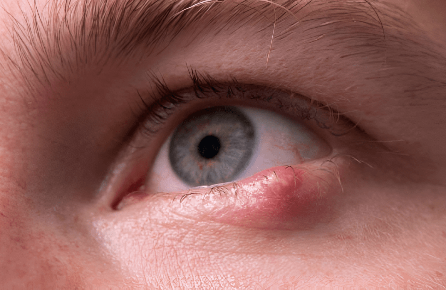 IDI Kota Tegal Sampaikan Informasi Pengobatan pada Penyakit Bintitan Mata