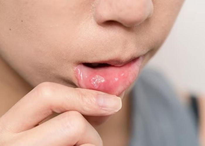 7 Cara Mengobati Sariawan agar Cepat Hilang dan Tidak Perih, dari Obat Alami hingga Medis