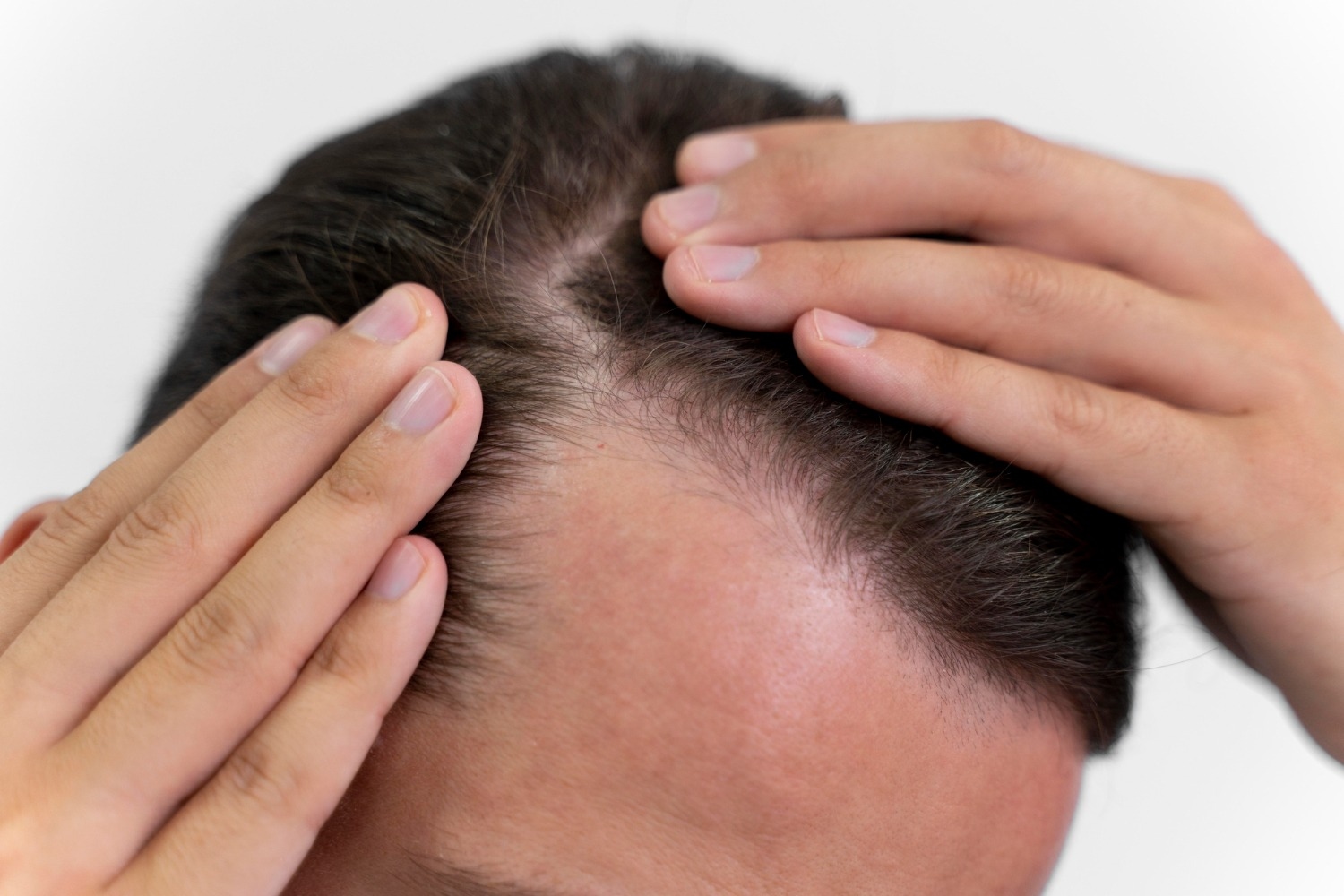 Kenali Jenis Kerontokan Rambut sebelum Terlambat dan Penanganannya
