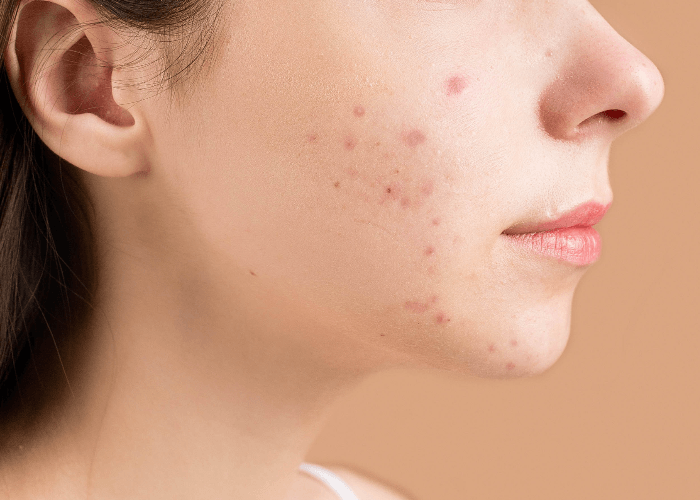 Jarang Diketahui! 5 Tips Menghilangkan Bekas Jerawat Secara Alami