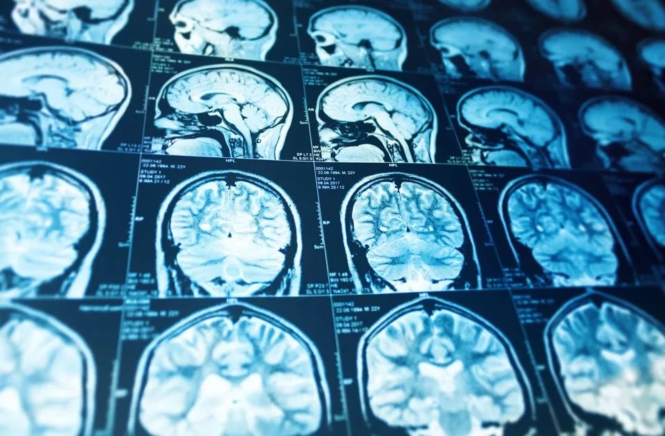 Manfaat Puasa bagi Kesehatan Otak Menurut Dokter Ahli