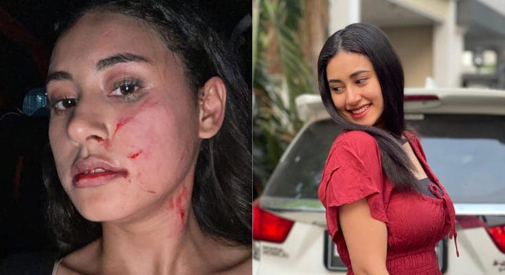 Kronologi Afifah Riyad Diserang Mantan Pacar Suami Hingga Babak Belur, Ada Luka Cakar Di Seluruh Tubuh