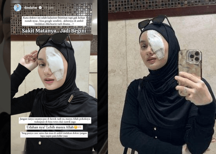 Mata Dinda Hauw Harus Diperban Usai Alami Kalazion, Penyakit Apa Itu?