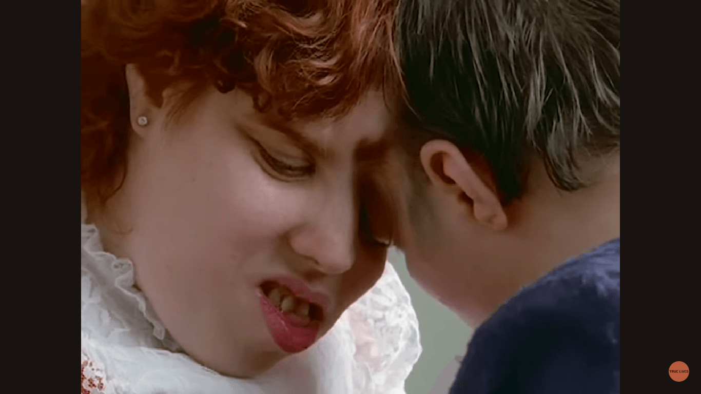 Kembar Siam Tertua di Dunia Wafat di Usia 62 Tahun