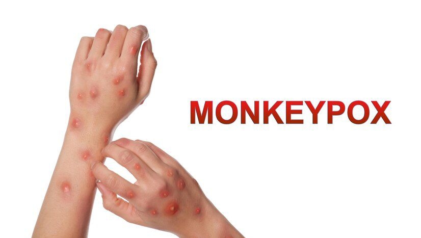 WHO: Wabah Mpox di Afrika Diperkirakan Berakhir dalam 6 Bulan