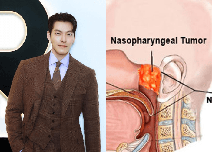 Mengenal Penyakit Kanker Nasofaring yang Pernah Diidap Aktor Kim Woo Bin, Ini Gejala dan Pengobatannya