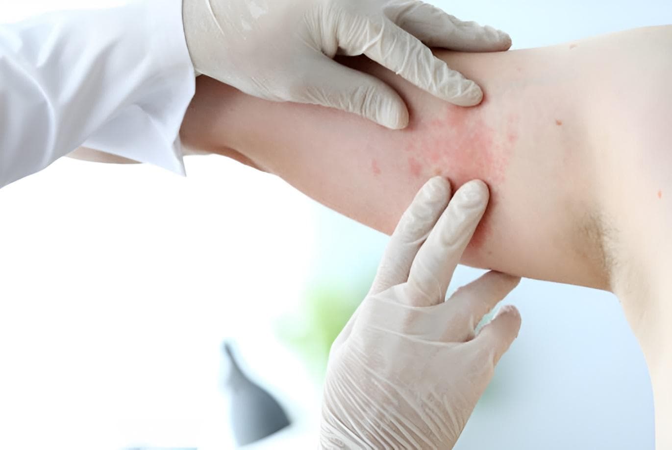 Kenali Alergi Susu, IDI Kabupaten Kebumen Berikan Informasi Pengobatan yang Tepat