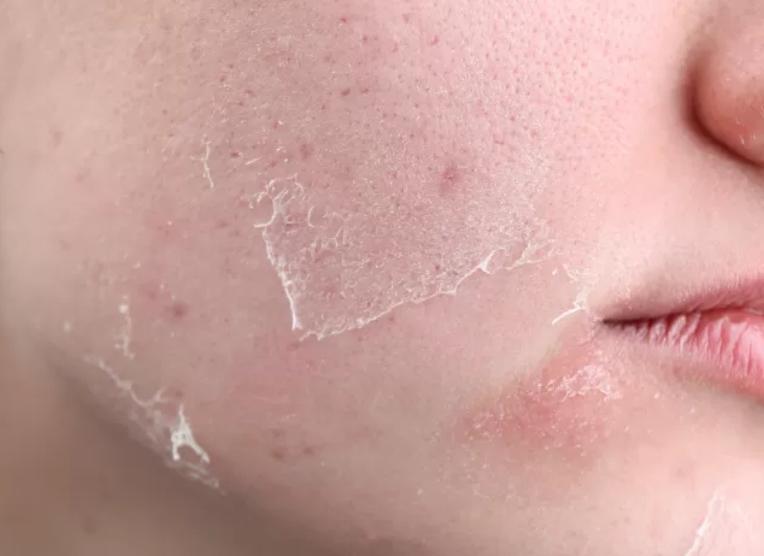 Dampak Puasa Bagi Kulit dan Cara Menjaganya Tetap Sehat