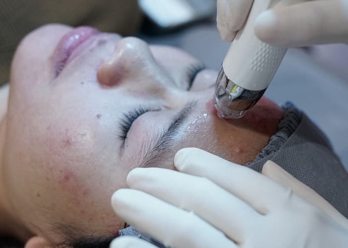 Cara Alami Hilangkan Bekas Luka di Wajah dengan Cepat