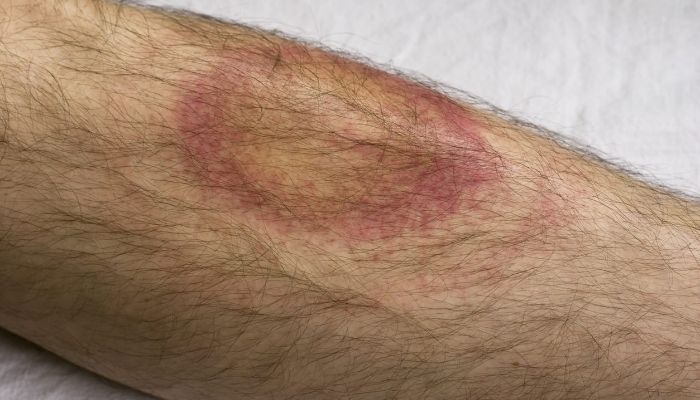 Apa Itu Penyakit Lyme? Simak Penyebab, Gejala, dan Pengobatannya