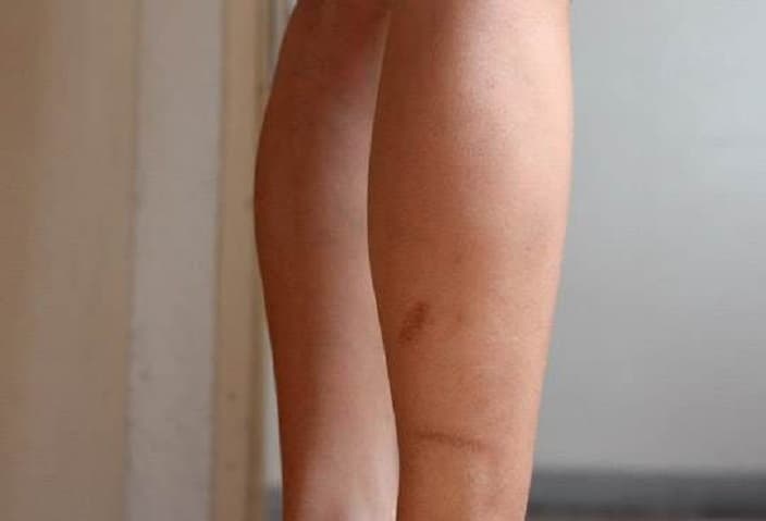 7 Cara Alami agar Luka Cepat Sembuh dan Tidak Berbekas