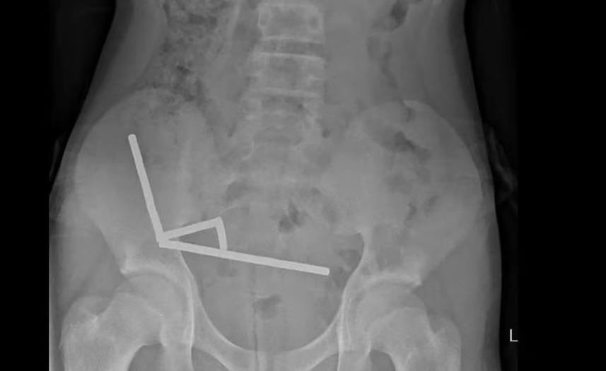 Tragis! Anak 13 Tahun Kehilangan Sebagian Usus Karena Mainan Magnet