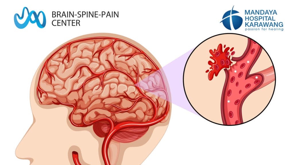 Waspadai Stroke Hemoragik: Paling Berbahaya yang Harus Dikenali