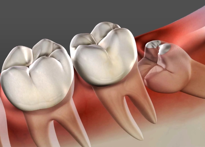 Berapa Lama Gigi Bungsu Tumbuh? Ini Waktu Normalnya