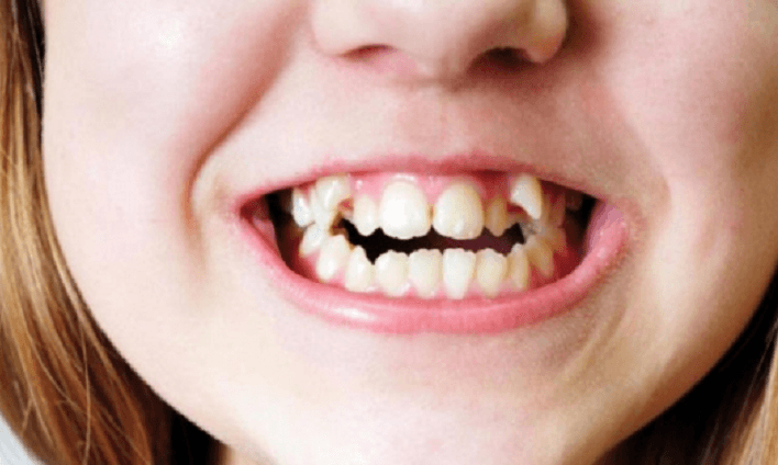 Gigi Tonggos: Penyebab, Dampak dan Cara Mengatasinya