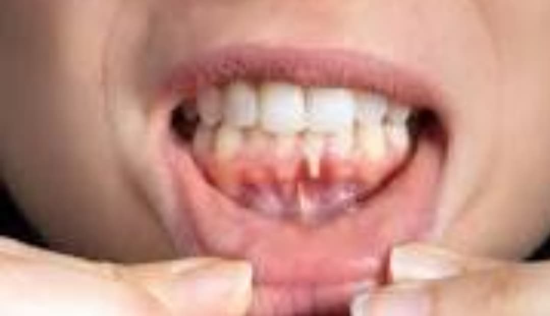 Penyebab Gusi Sering Berdarah yang Perlu Diwaspadai