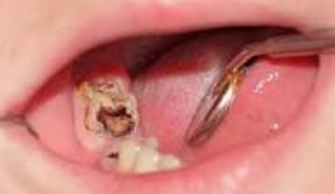 Tanda-tanda Gigi Harus Dicabut dan Kapan Anda Perlu ke Dokter