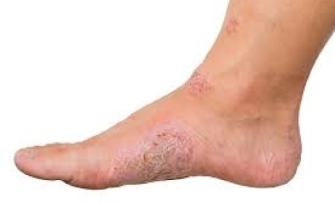 Tips Ampuh Rawat Luka Diabetes agar Cepat Sembuh