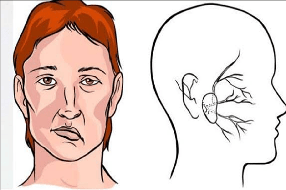 Jangan Sering Dimakan, 7 Makanan Ini Bisa Tingkatkan Risiko Stroke